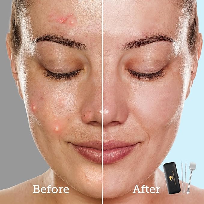 LitBear Pore Prep Tool, Blackhead Remover Pimple Popper Tool Kit, Stainless Steel Blackhead Extractions Tool for Acne, Whitehead Popping, Blemish, Comedone, Black-BrightBean Baby