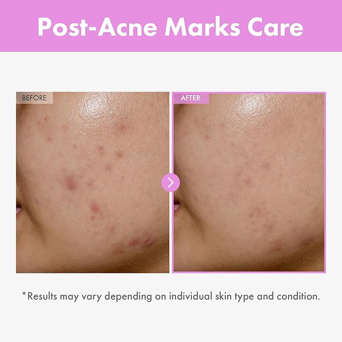 9 Peptide Skin Booster Serum, Niacinamide & Hyaluronic Acid Skin Renewal Boosting Facial Essence for All Skin Types, Korean Skin Care, Paraben Free, 150ml, 5.07 fl.oz.-BrightBean Baby