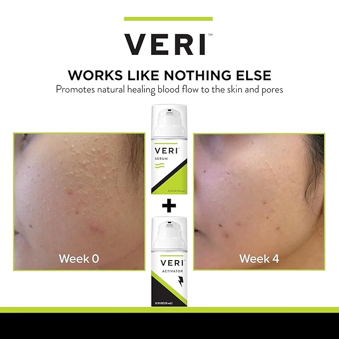 VERI Nitric Oxide + Salicylic Acid Clear Skin System (Peroxide-Free): For Acne Prone Skin, Unclogs Pores, Clarifies Blemishes, Reduces Inflammation, Prevent Future Breakouts, 30 mL / 1 oz-BrightBean Baby