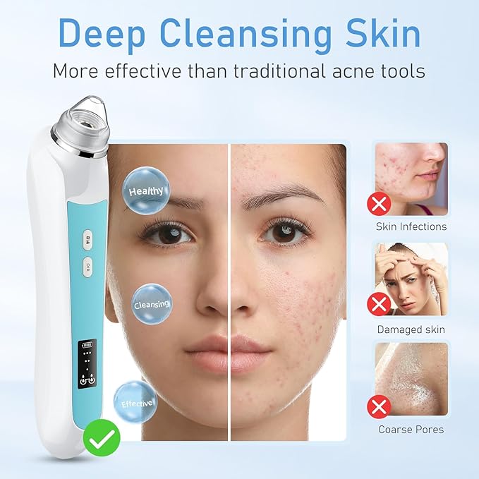 Facial Pore Blackhead Remover Vacuum, 1080P Camera Blackhead Remover, 20x Zoom, 8 LEDs ＆ 3 Suction Modes, 800mAh Battery & USB - 6 Heads Pore Cleaner Kit for Women&Men(Blue)-BrightBean Baby