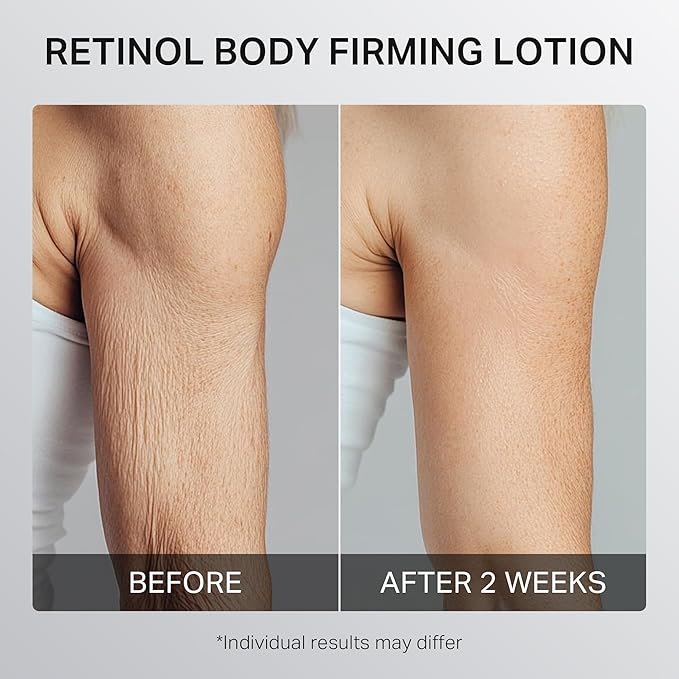 Ultra-Size Firming Retinol Body Lotion for Crepey Skin & Keratosis Pilaris with 0.05% Retinol, AHA, Collagen, Body Cream, Anti Aging Moisturizer 10.14 fl oz-BrightBean Baby