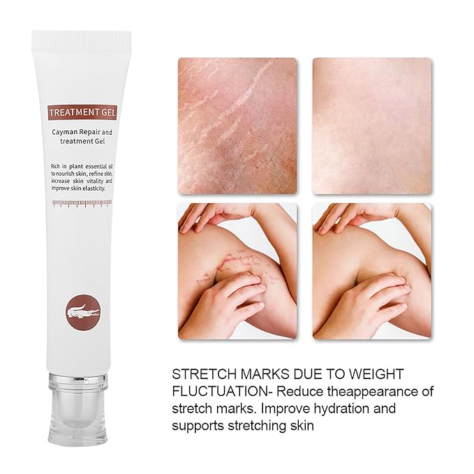 Generic Stretch Marks Removal Cream, Reduce Old Marks, Restore Elasticity, Firm & Lift Skin, Safe & Ingredients, 30g, Compact Size-BrightBean Baby