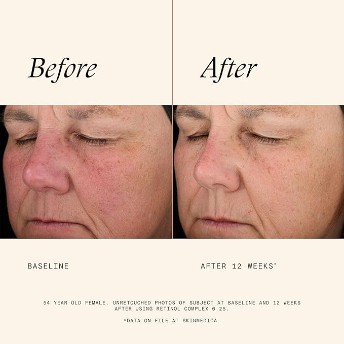 SkinMedica Retinol 0.25 Complex - Retinol Serum for Face, Age-Defying Advanced Retinol Cream That Renews Skin and Diminishes the Appearance of Fine Lines and Wrinkles, 1 Fl Oz-BrightBean Baby