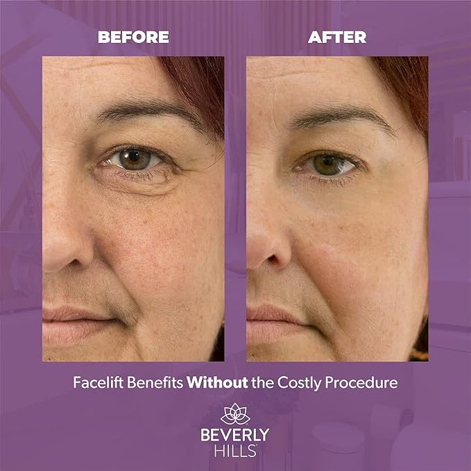 Beverly Hills V-Lift Instant Eye Lift and Eye Tuck Bee Venom Serum for Puffy Eyes, Dark Circles, Wrinkles, and Under Eye Bags Treatment for Women and Men | 30mL (120 Day Supply)-BrightBean Baby