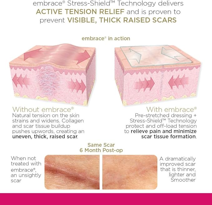 Embrace Active Scar Defense for New Scars, FDA-Cleared Silicone Scar Sheets, 2.4 Inch, Medium, 60 Day Supply (Recommended Treatment)-BrightBean Baby