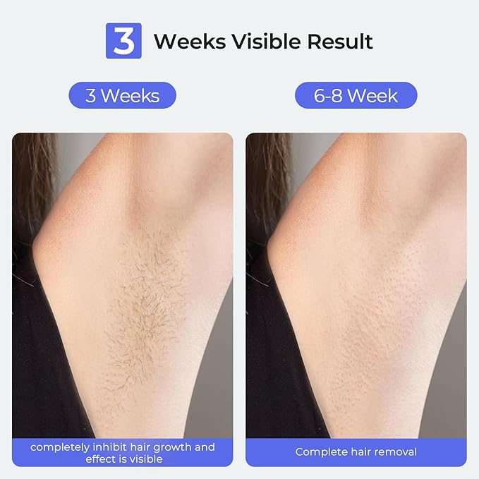 LUBEX Painless Sapphire Ice Cooling IPL Laser Hair Removal Device at Home for Women & Men, 1,000,000+ Unlimited Flashes, Safe and Permanent, Alternative to Salon Hair Removal for Face, Body, Bikini-BrightBean Baby