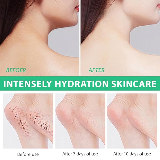 J&H Jasmine&Hyacinth 40% Urea Cream with 2% Salicylic Acid, Aloe, Feet/Heel Cream Moisturizer for Dry Cracked Heel, Knees, Elbows, Hands, Callus Remover, Intensive Hydrating Treatment-5.3 OZ/150 G-BrightBean Baby