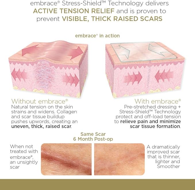 Embrace Scar Treatment, Silicone Sheets for New Scars with Active Scar Defense, Extra Large 6.3 Inch Sheets, 60 Day Supply (Recommended Treatment)-BrightBean Baby