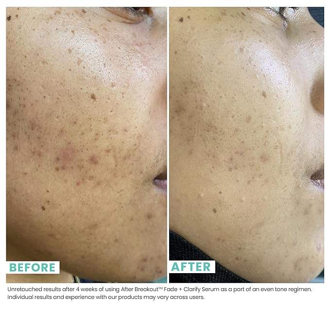 Urban Skin Rx, Acne & Dark Spot Essentials Starter Kit, Includes Clear Skin Cleansing Bar, Acne Serum + Spot Treatment & Fade + Clarify Serum, Cleanses Pores, Fades & Fights Breakouts-BrightBean Baby