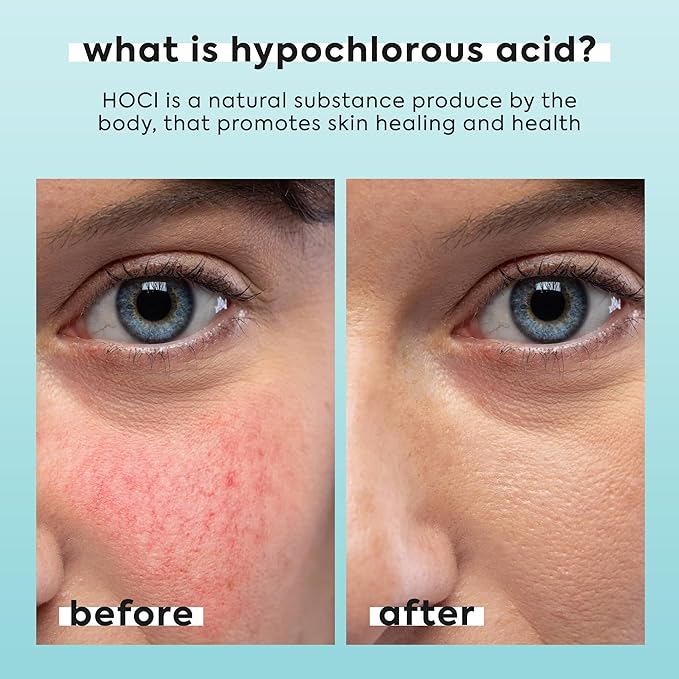 Hypochlorous Acid Spray for Face & Body - Helps Reduce Redness and Breakouts - Travel Size Hypochlorous Spray, Multi-Purpose Topical Facial Skin Repair, pH-Balancing Toner - TSA, Livaclean-BrightBean Baby