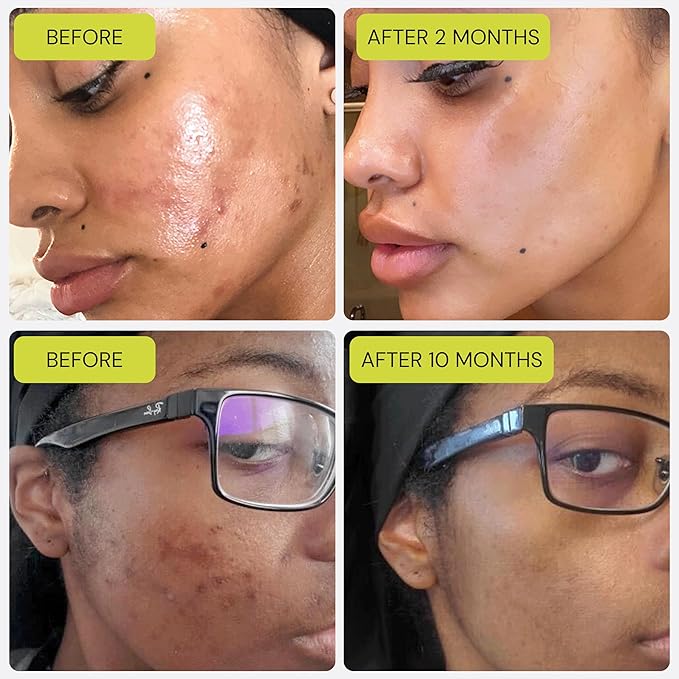 Gleamin Vitamin C Clay Mask for Dark Spots, Turmeric Clay Face Mask Skin Care, Deeply Cleanses & Refines Pores, Brightens Uneven Tone and Helps Improve Post-Blemish Scarring & Texture - 5 Oz-BrightBean Baby