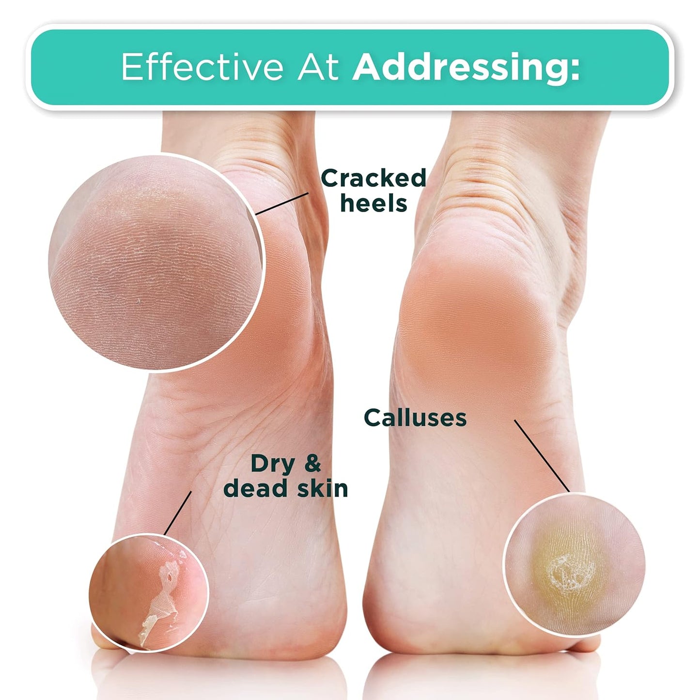 DERMORA Foot Peel Mask | Skin Exfoliating Foot Masks | Dry, Cracked Feet, Callus, Dead Skin Remover | Baby Soft Feet, Tea Tree Scent | Pack of 2 | Regular-BrightBean Baby