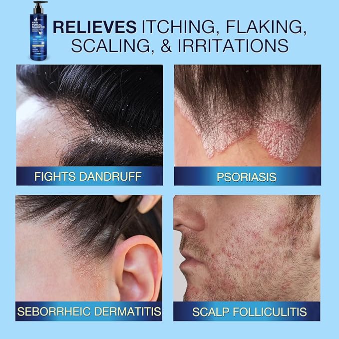 Anti-Fungal Shampoo for Scalp Psoriasis: Dandruff Shampoo for Folliculitis and Seborrheic Dermatitis - Relieves Itchy & Dry Scalp - 300 mL / 10.1 fl.oz-BrightBean Baby