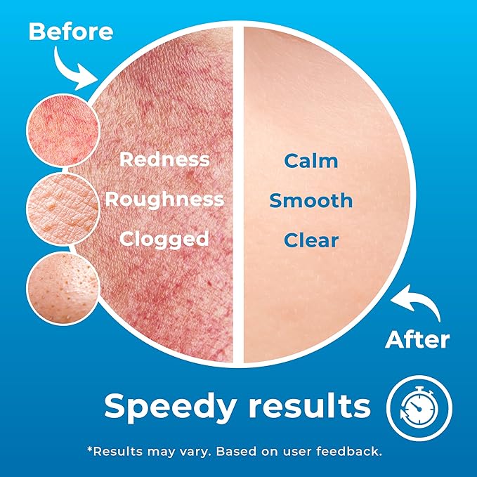 Hypochlorous Acid Spray (8oz, Reduces Acne), Targets Bacteria - HOCL Facial Cleanser Acne Spray for Face, Body, Eczema, Pimples, Breakouts & Overall Skin Recovery (Reduces Redness)-BrightBean Baby