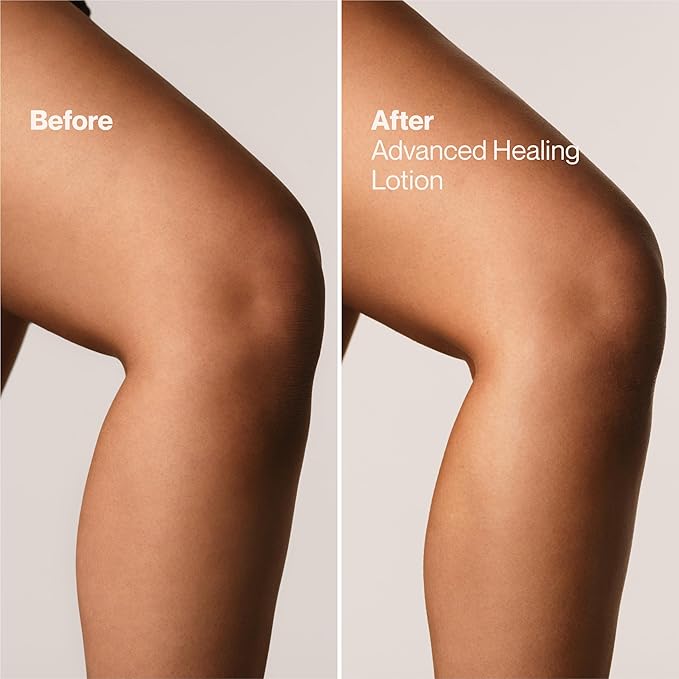 Suave+ Advanced Healing Hand & Body Lotion for Women With Ceramides for Very Dry Skin, Hydrating, Non-Greasy, Allergen-Free Moisturizing Cream, Lightly Scented, 18 FL OZ, 6 Pack-BrightBean Baby