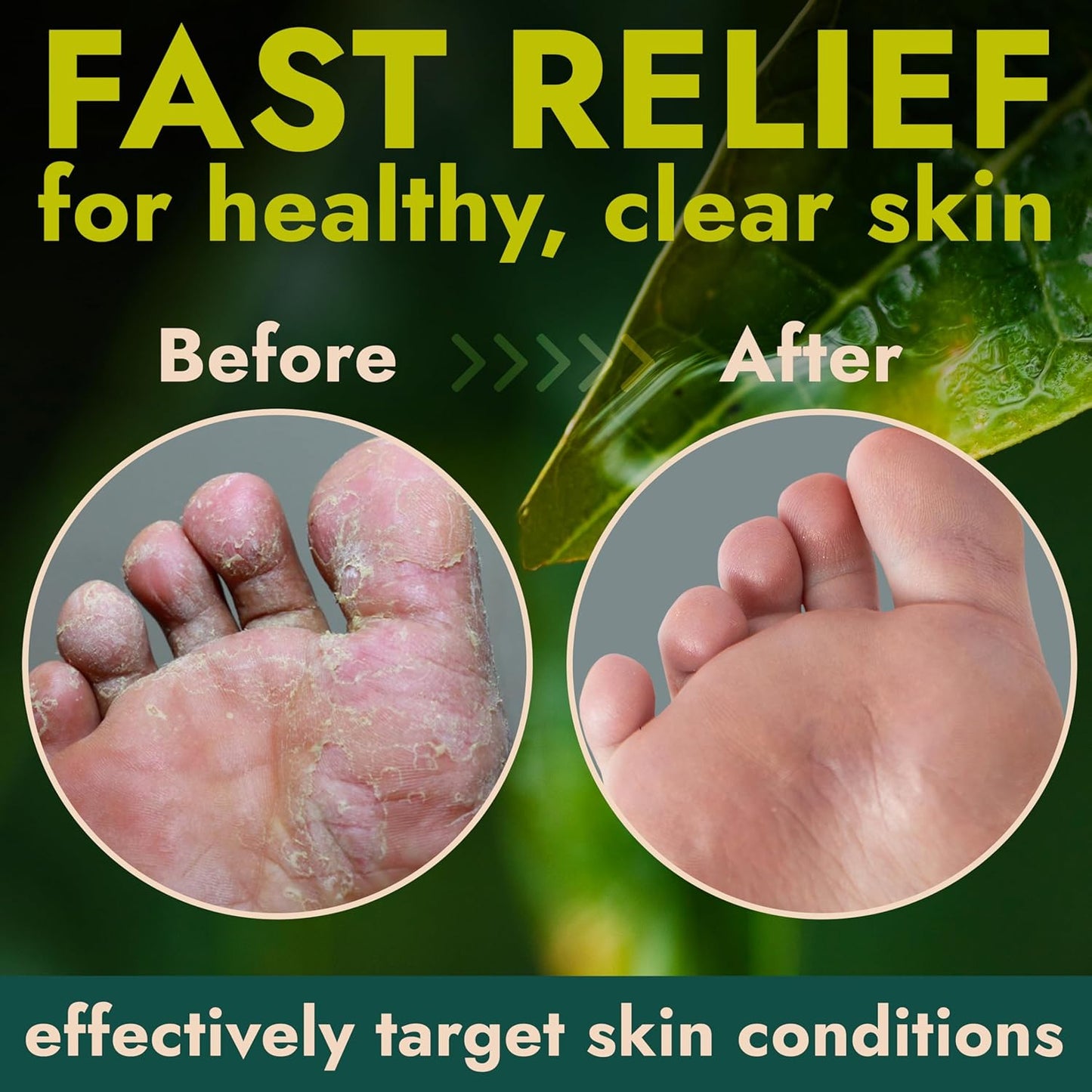 Foot Cream with Tea Tree Oil | Antifungal Cream to Soothes Cracked Heels, Dry Skin & Itchy Feet | Helps with Athlete’s Foot, Nail Fungus & Jock Itch | Relieves Itching & Burning | 4.05 fl oz-BrightBean Baby