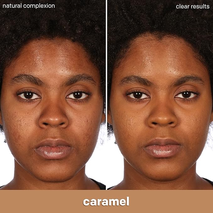 Almay Clear Complexion Acne Foundation Makeup with Salicylic Acid - Lightweight, Medium Coverage, Hypoallergenic, Fragrance-Free, for Sensitive Skin, 800 Caramel, 1 fl oz.-BrightBean Baby