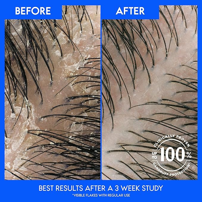 Head & Shoulders Itchy Scalp Care Dandruff Shampoo, Anti-Dandruff Treatment, Infused with Eucalyptus, 32.1 Fl Oz Each, Twin Pack-BrightBean Baby